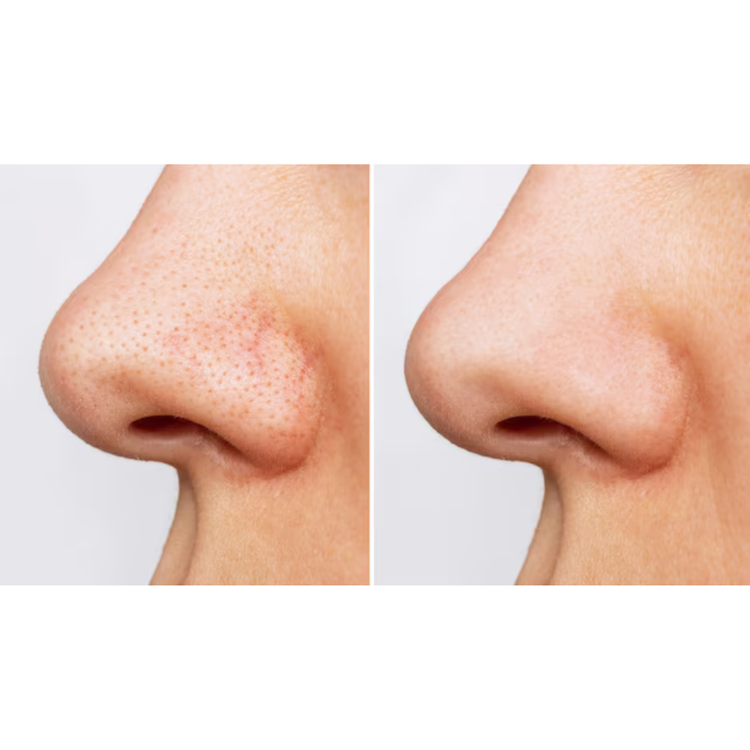 KIT Doble Limpieza Poros + Puntos Negros